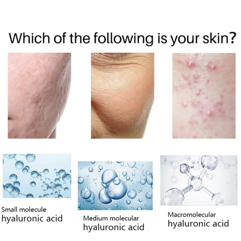 20% Glycolic & Salicylic Acid Essence – Pore Shrinking & Acne Treatment